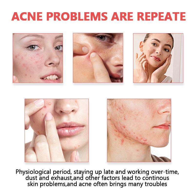 여드름 패치 투명 하이드로콜로이드 뾰루지 커버 오일 컨 - Skincare Oil Control 리뷰 및 가격